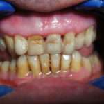 Direct Laminate Veneers at Dental Clinic Mumbai