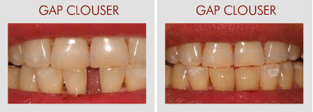 Gap Closure And Missing Tooth Replacement