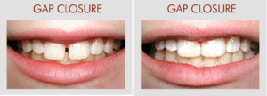 Gap Closure And Missing Tooth Replacement