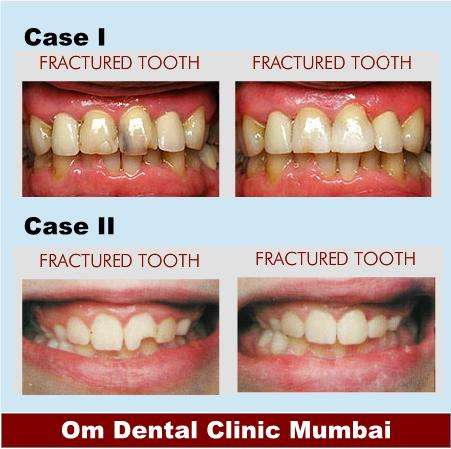 Dental care in Mumbai for fractured tooth