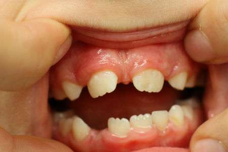Missing Teeth: Regain with Dental Implants