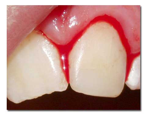 Alert On Bleeding Gums Causes. Credit: http://anchoragedentalnews.com