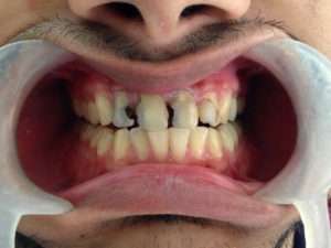 Dental Crowns - Teeth Done Up With Zirconia Metal Free Crowns
