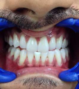 After Teeth Whitening - Dentist in Juhu