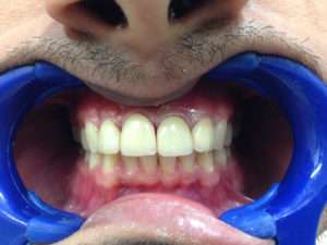 After Treatment With Zirconia Metal Free Crowns