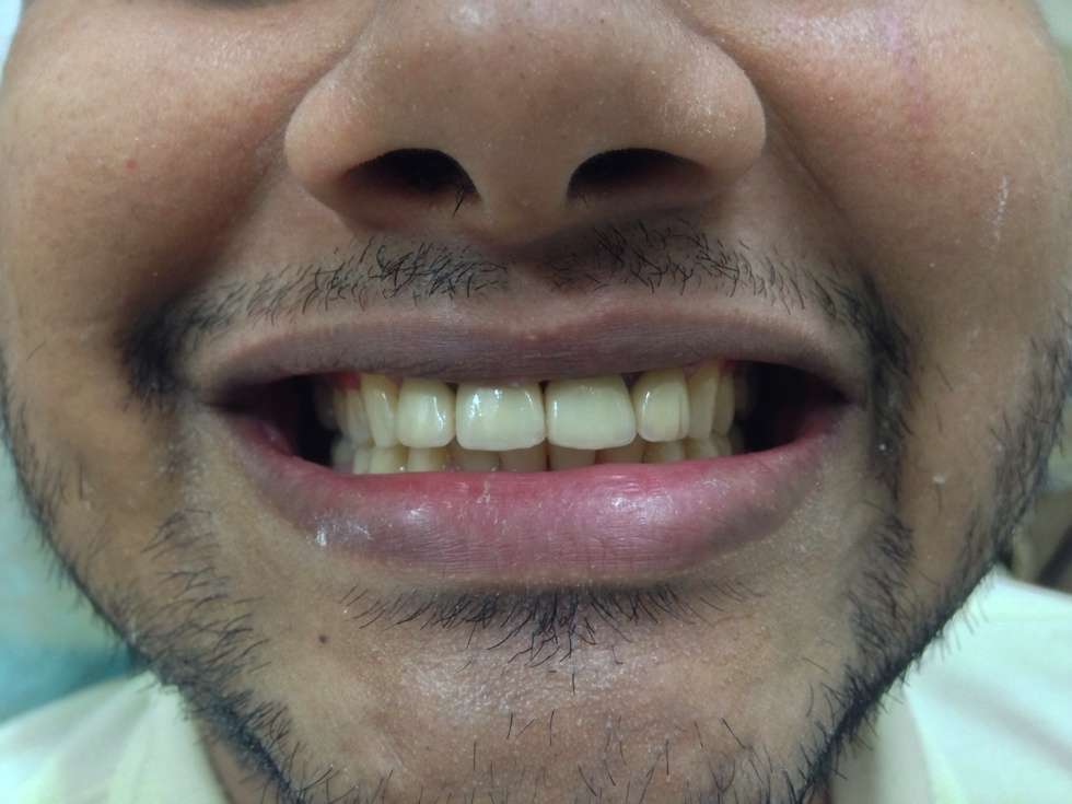 Smile Improvement by Dentists Near Bandra