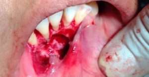 Orthodontic Treatment - 2