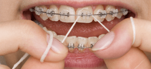Dental Care with Braces Image Credits: monashdentalgroup