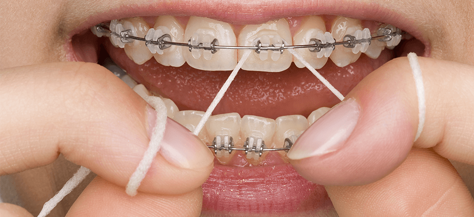 Braces for improving Bite by Dentist in Mumbai