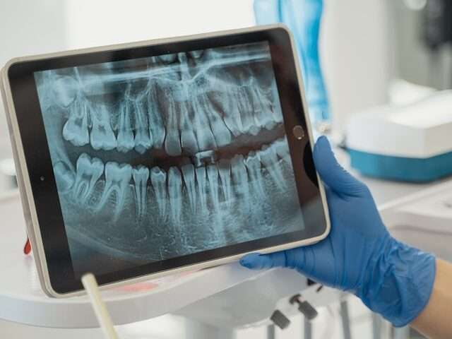 root-canal-treatment-mumbai